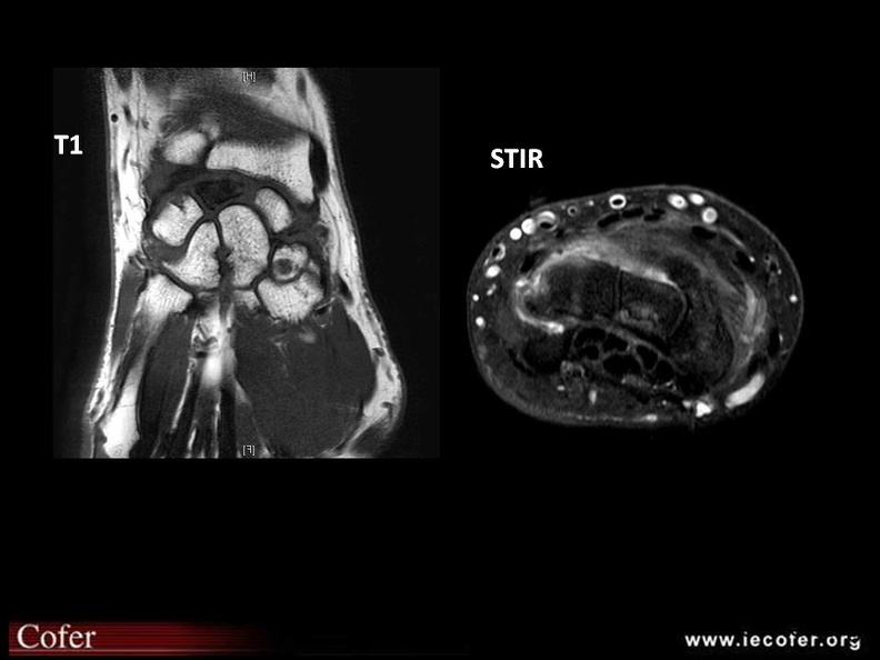 ostéonécrose du lunatum -IRM En coupe coronale T1, le lunatum est en hyposignal; en coupe axiale STIR, il est hétérogène, il existe une image de fracture, et un rehaussement de la synoviale (arthrose secondaire). ON lunatum IRM -lafforgue - sep 2015.jpg
